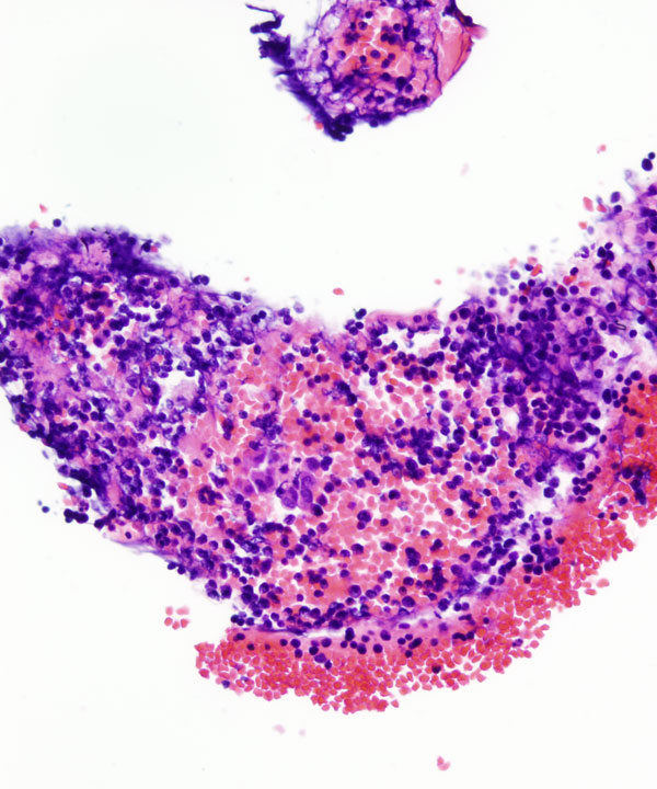 10 : Mediastinum Thymoma