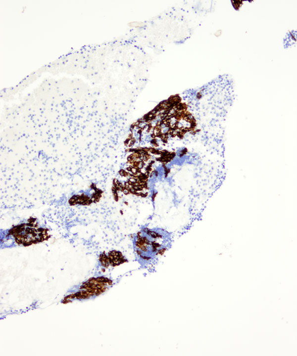11 : Mediastinum Thymoma