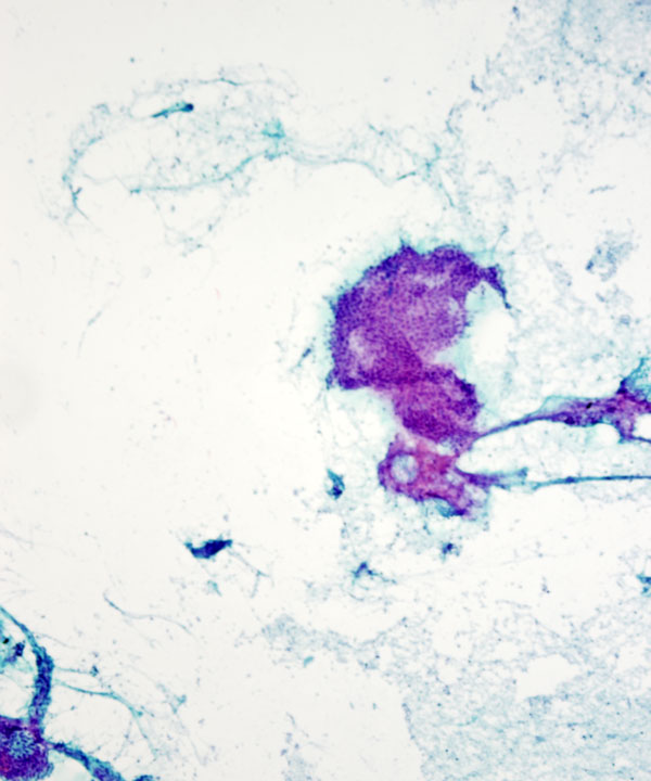 12 : Mediastinum Thymoma
