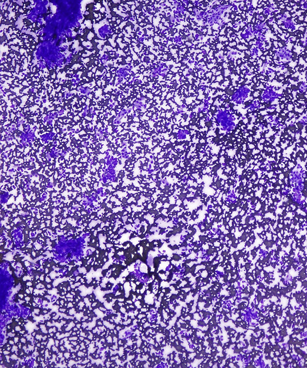 image showing 'Medullary Thyroid Carcinoma'