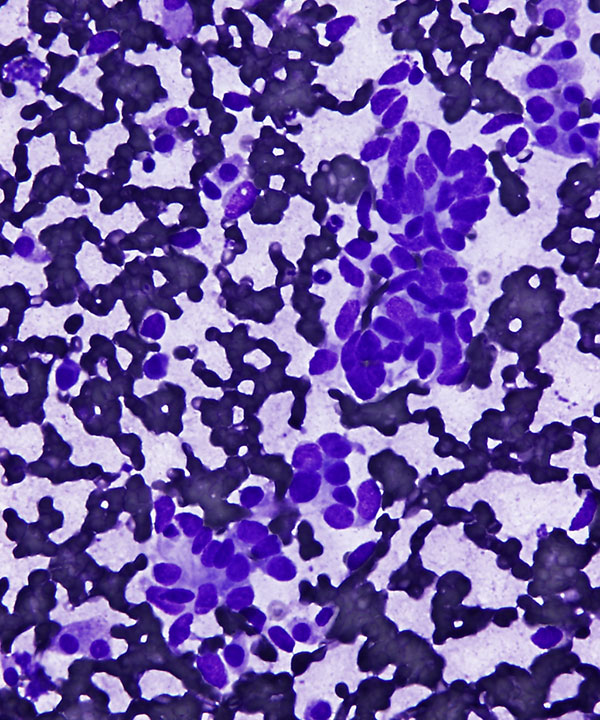 02 : Medullary Thyroid Carcinoma