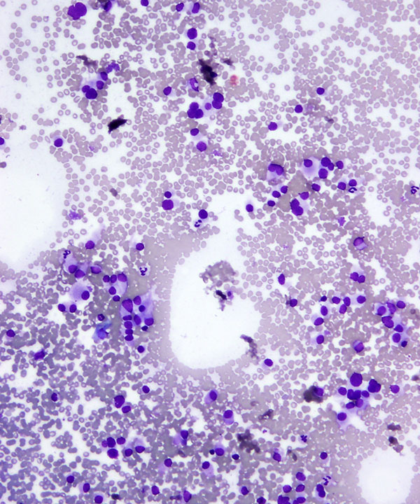 03 : Medullary Thyroid Carcinoma