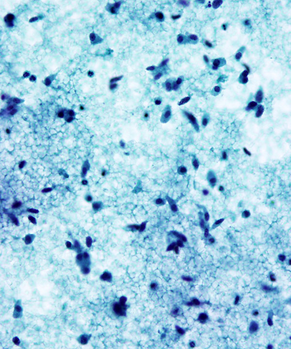 06 : Medullary Thyroid Carcinoma