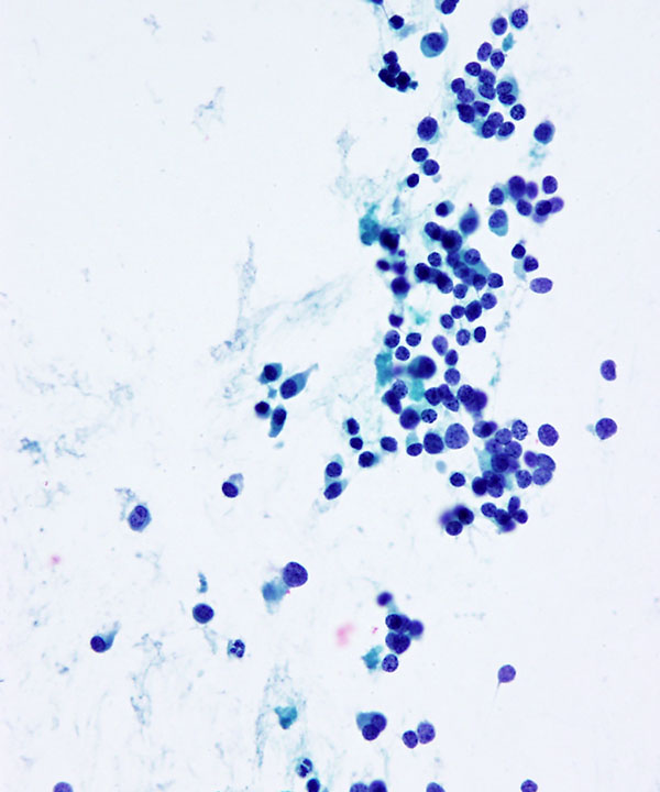 07 : Medullary Thyroid Carcinoma