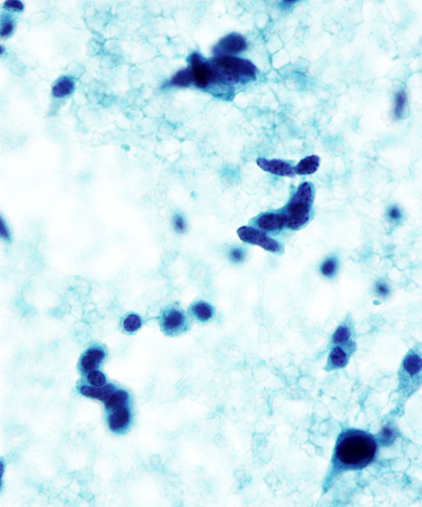 08 : Medullary Thyroid Carcinoma