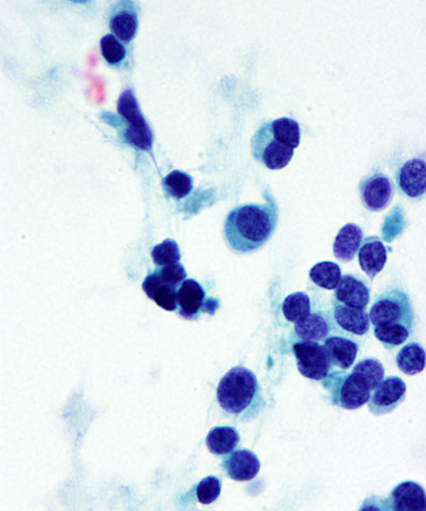 11 : Medullary Thyroid Carcinoma