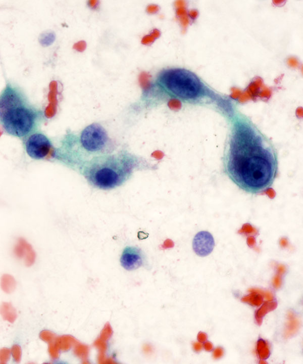 07 : Acinar Cell Carcinoma