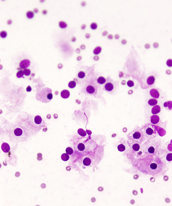 08 : Acinar Cell Carcinoma