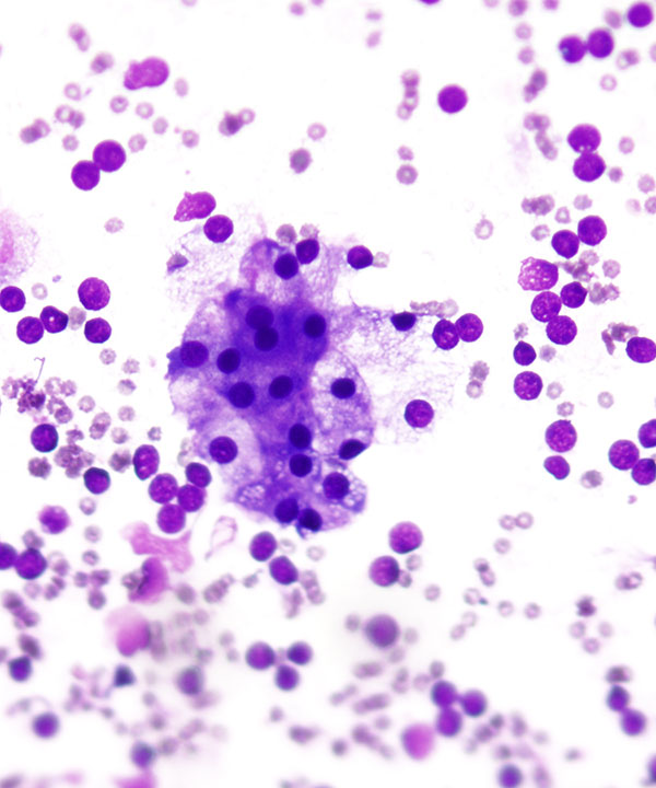 09 : Acinar Cell Carcinoma