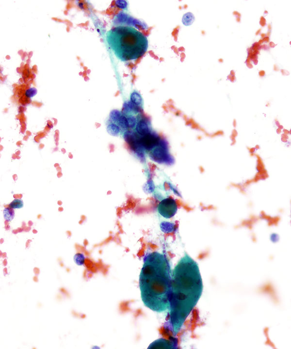 10 : Acinar Cell Carcinoma
