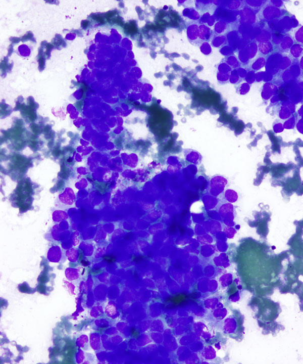 02 : Pancreas Ductal Adenocarcinoma