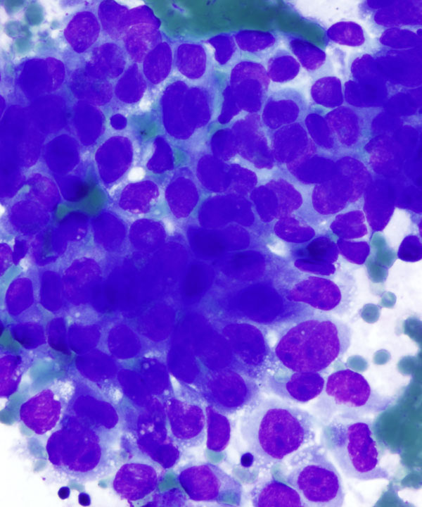 03 : Pancreas Ductal Adenocarcinoma