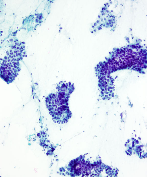 04 : Pancreas Ductal Adenocarcinoma