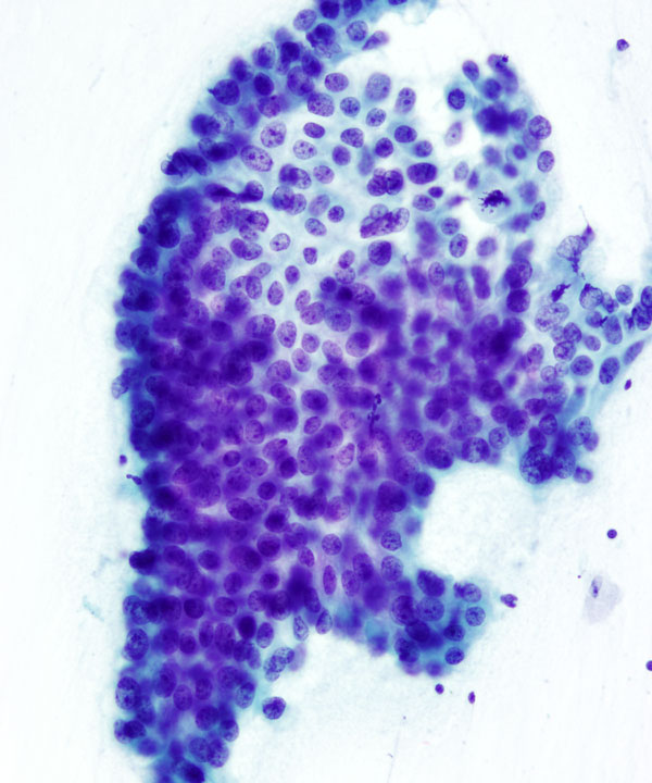 05 : Pancreas Ductal Adenocarcinoma