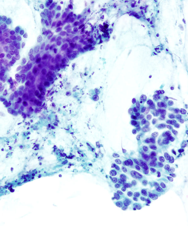 06 : Pancreas Ductal Adenocarcinoma