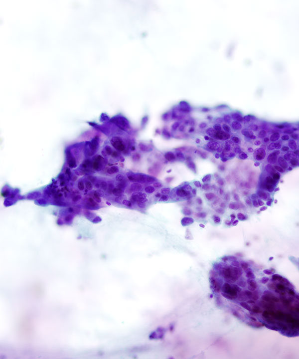 08 : Pancreas Ductal Adenocarcinoma