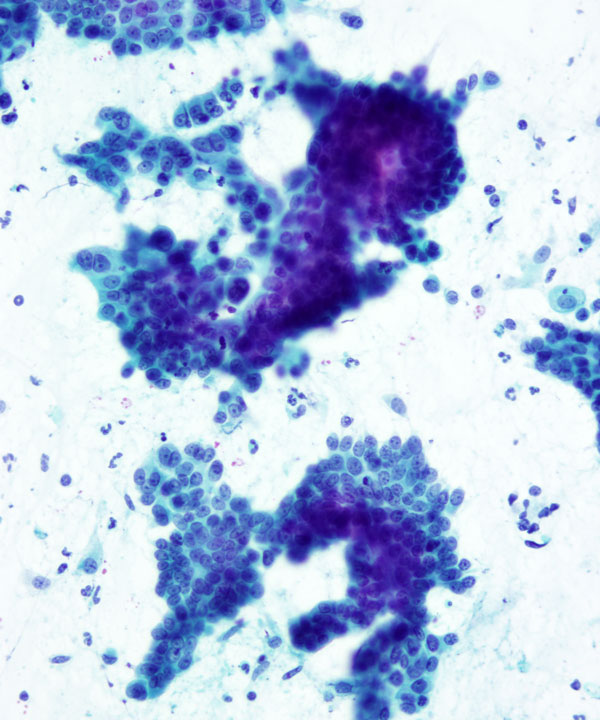 09 : Pancreas Ductal Adenocarcinoma