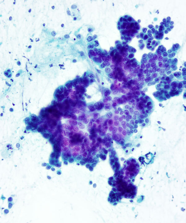 10 : Pancreas Ductal Adenocarcinoma
