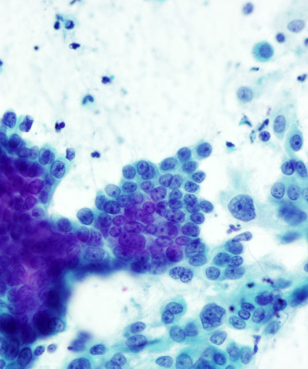 11 : Pancreas Ductal Adenocarcinoma
