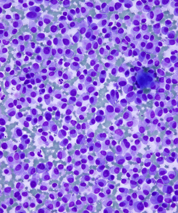 2 : Pancreas Neuroendocrine Tumor Low Grade
