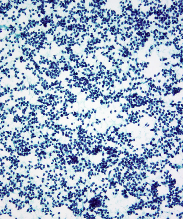 3 : Pancreas Neuroendocrine Tumor Low Grade