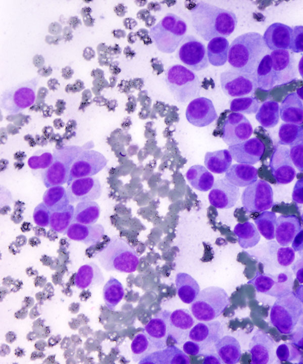 4 : Pancreas Neuroendocrine Tumor Low Grade