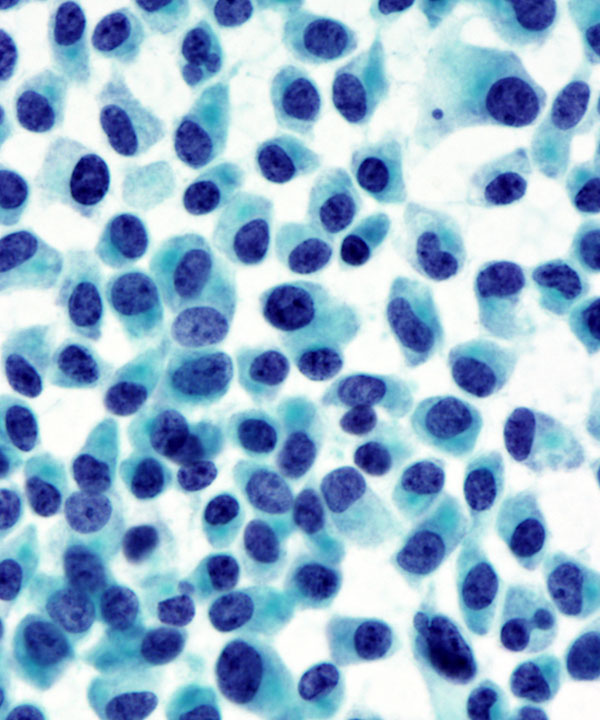5 : Pancreas Neuroendocrine Tumor Low Grade