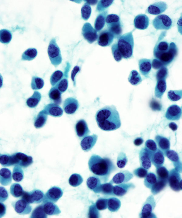 6 : Pancreas Neuroendocrine Tumor Low Grade