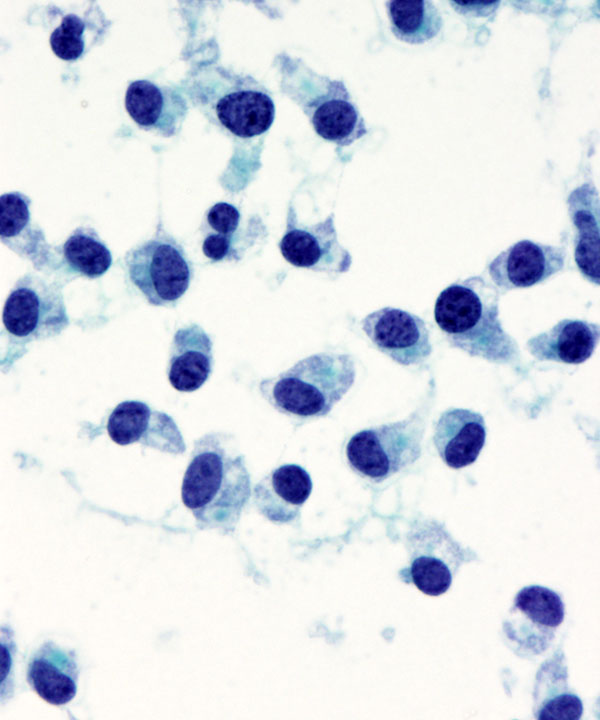 7 : Pancreas Neuroendocrine Tumor Low Grade