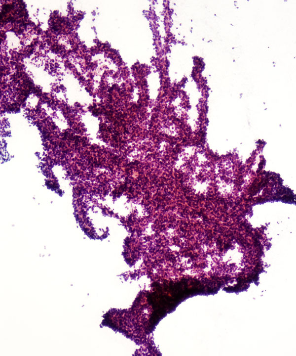 02 : Solid Pseudopapillary Neoplasm