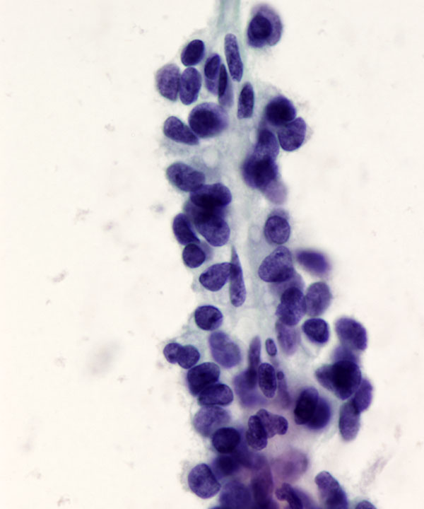 03 : Solid Pseudopapillary Neoplasm