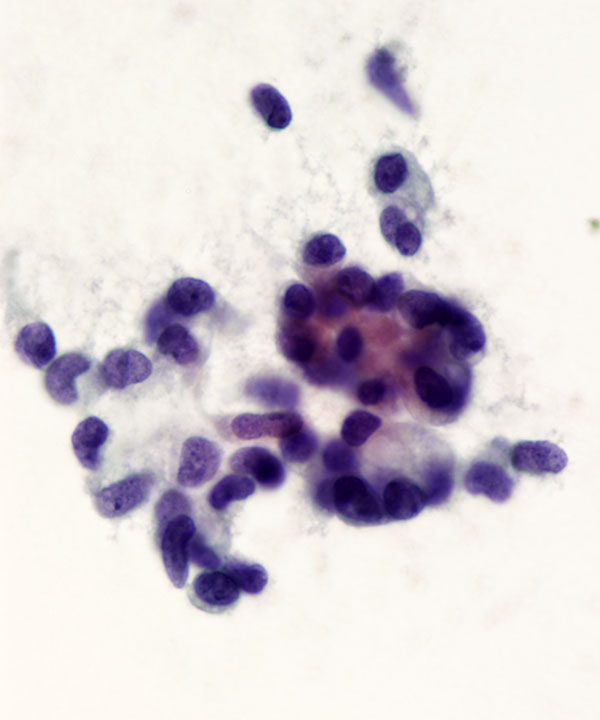 05 : Solid Pseudopapillary Neoplasm