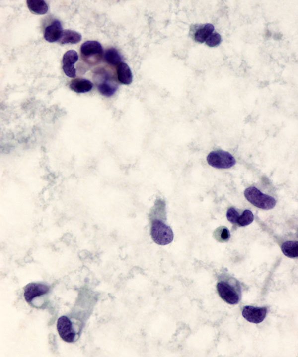 06 : Solid Pseudopapillary Neoplasm