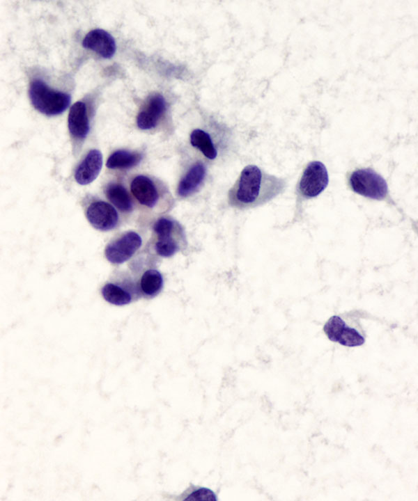 07 : Solid Pseudopapillary Neoplasm