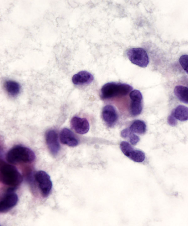 09 : Solid Pseudopapillary Neoplasm