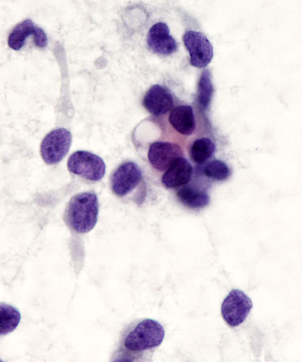 10 : Solid Pseudopapillary Neoplasm