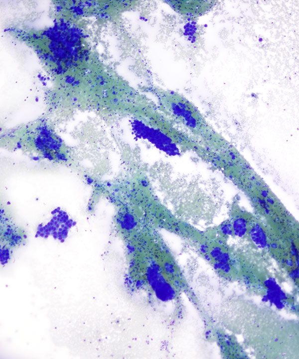 image showing 'Renal Medullary Carcinoma'