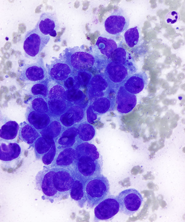 03 : Kidney Renal Medullary Carcinoma