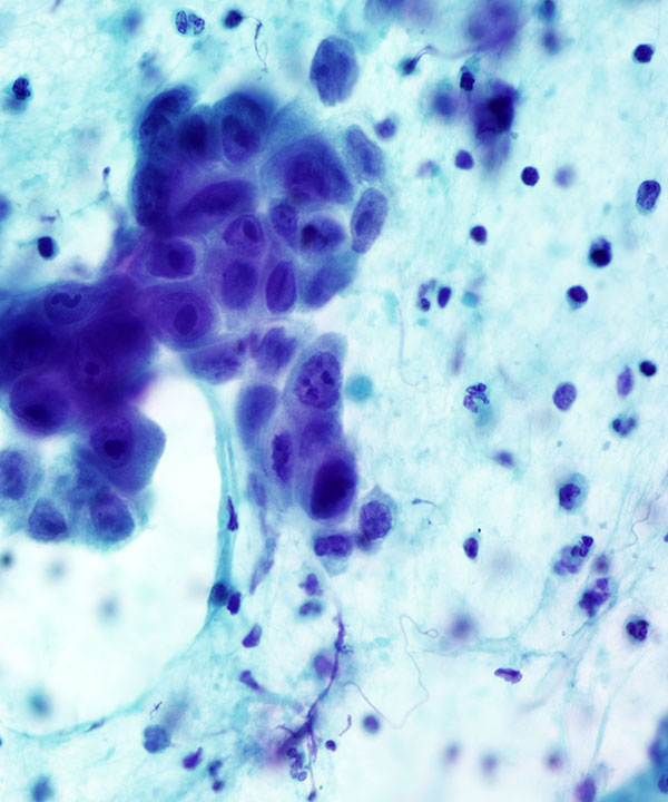 04 : Kidney Renal Medullary Carcinoma