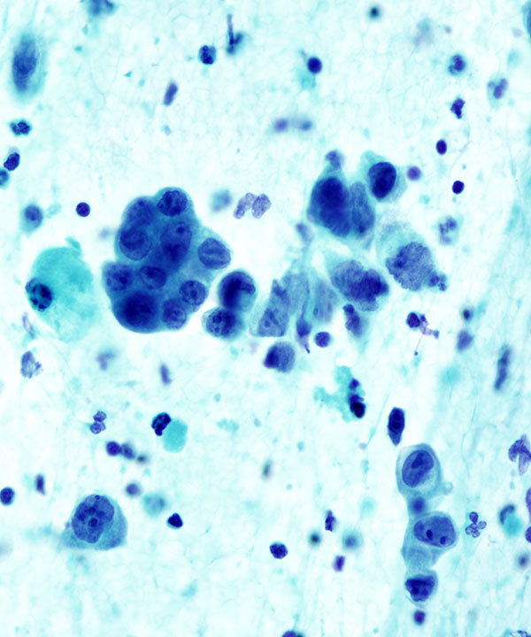 05 : Kidney Renal Medullary Carcinoma