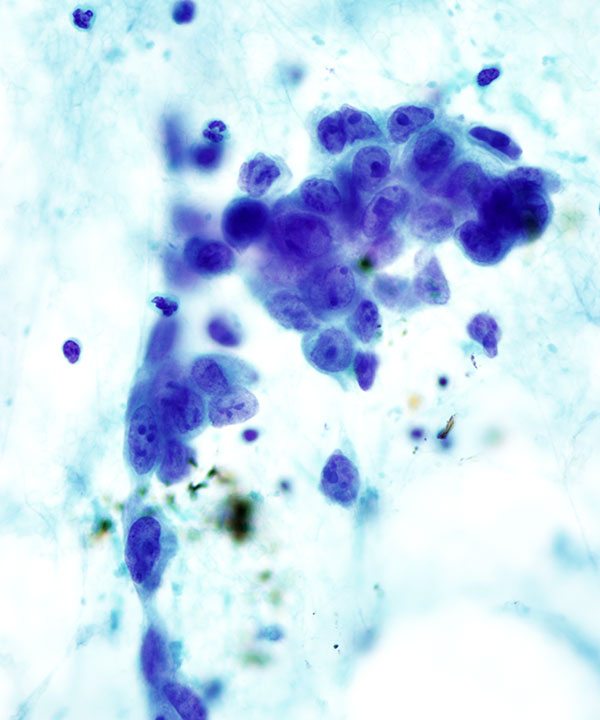 06 : Kidney Renal Medullary Carcinoma