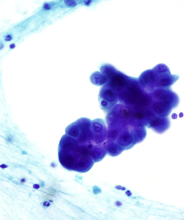 07 : Kidney Renal Medullary Carcinoma