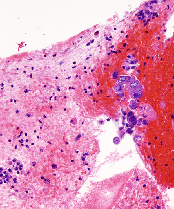08 : Kidney Renal Medullary Carcinoma