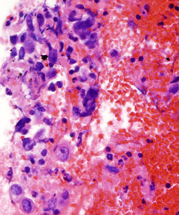 09 : Kidney Renal Medullary Carcinoma