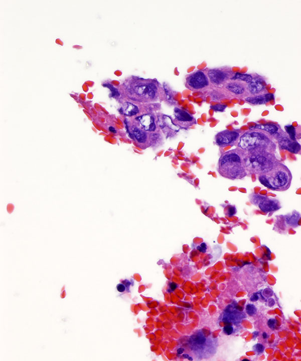 10 : Kidney Renal Medullary Carcinoma