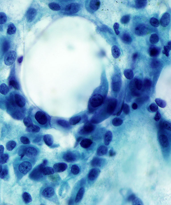 image showing 'Salivary Duct Carcinoma'