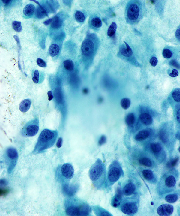 02 : Salivary Duct Carcinoma