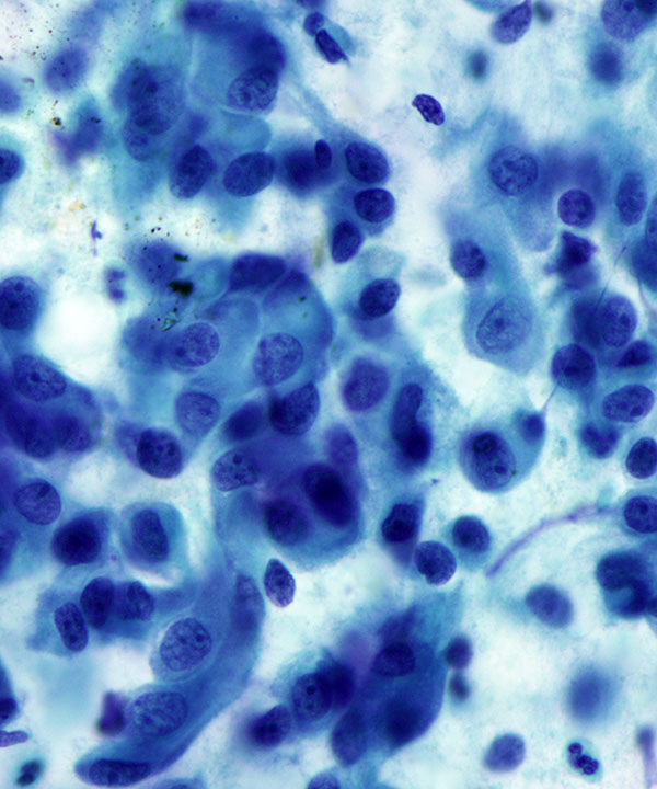 03 : Salivary Duct Carcinoma