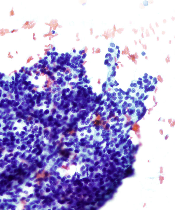 02 : Salivary Gland Acinic Cell Carcinoma