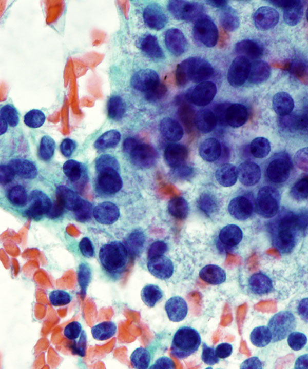 04 : Salivary Gland Acinic Cell Carcinoma